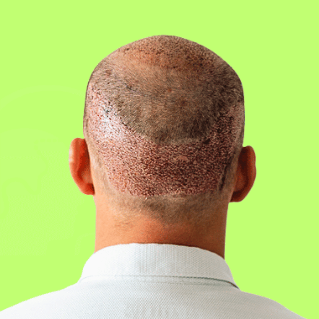 mikropigmentacja blizn scalpmann