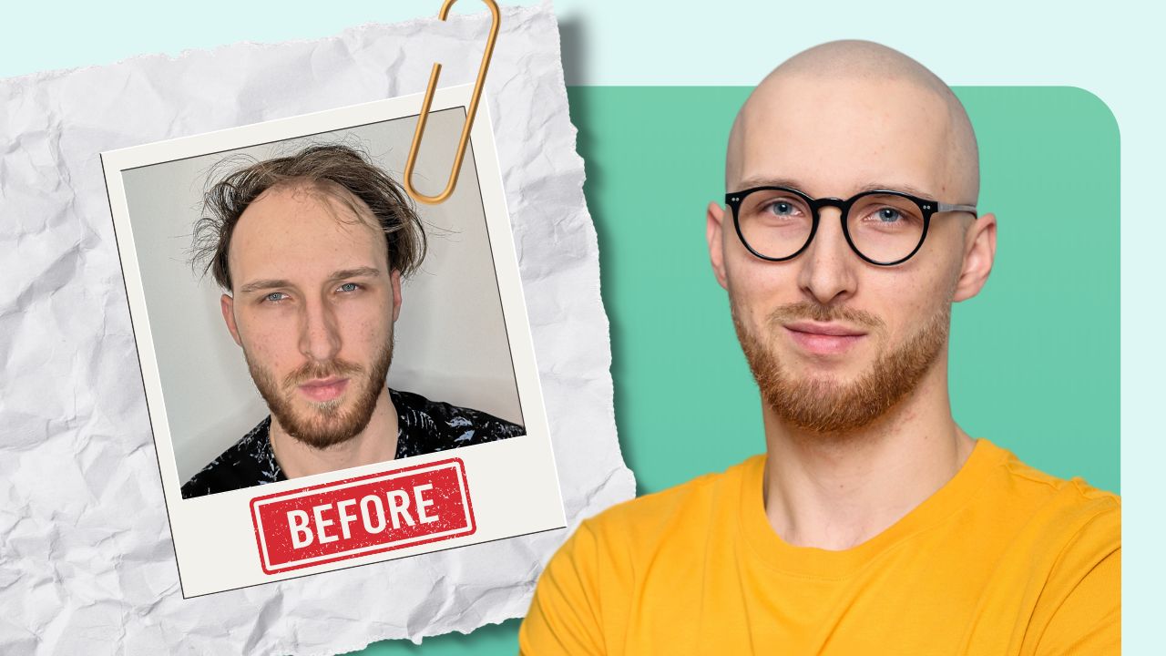 Metamorfoza Karola mikropigmentacja skóry głowy efekty przed i po zabiegu
